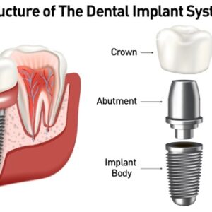 Dental Implants: A Modern Solution for a Confident Smile